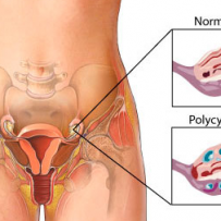 POLYCYSTIC OVARY SYNDROME/STEIN – LEVENTHAL SYNDROME (PCOS)