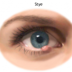 Easy Health and Living: 3 ways to treat styes