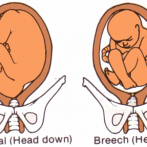 BREECH BABY PRESENATATION