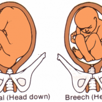 BREECH BABY PRESENATATION